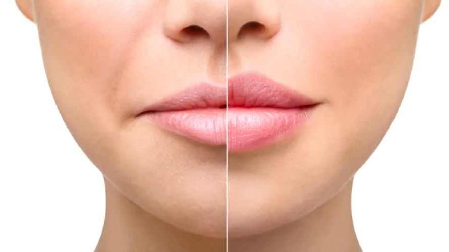 Dermal fillers 